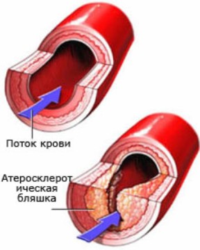 Атеросклероз, как избежать серьезных проблем